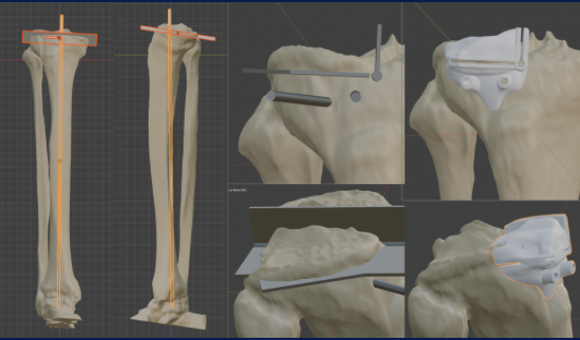 Guía personalizada para prótesis unicompartimental de rodilla