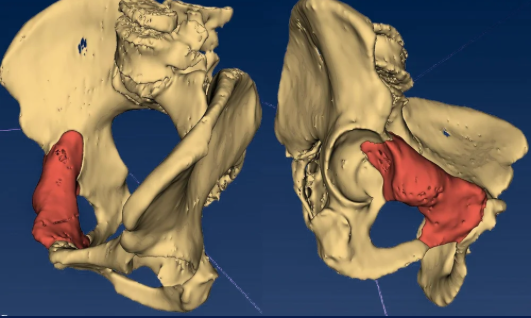 Segmentación 3D de condrosarcoma intraóseo de pelvis
