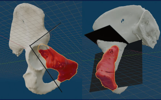 Planificación de planos de osteotomía para resección de pelvis