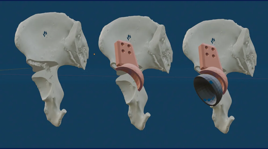 Simulación virtual de implantes de reconstrucción pélvica