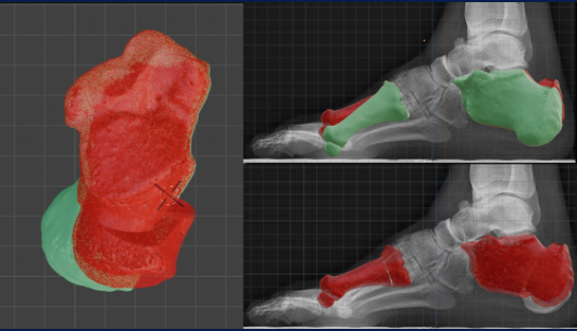 Segmentación y cruce de radiografías con tomografía para planificación de pie cavo