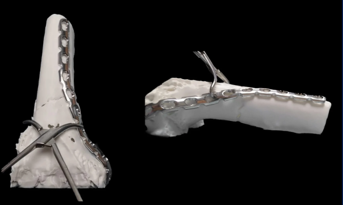 Biomodelo impreso con placa de osteosíntesis premoldeada sobre la anatomía del paciente