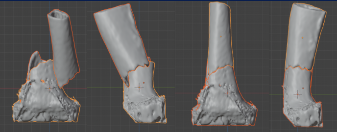 Segmentación y reducción virtual del fémur distal, cuatro vistas del modelo 3D