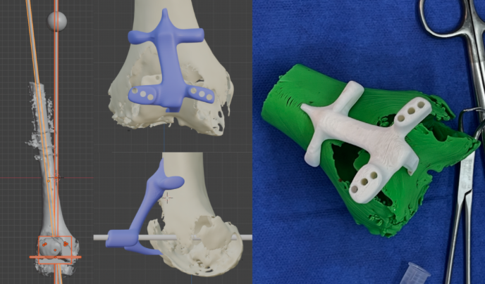 Planificación virtual y guía de corte impresa para prótesis de rodilla con vástago largo de cadera