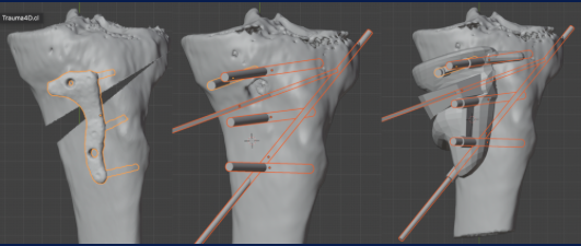 PSI en osteotomía de tibia